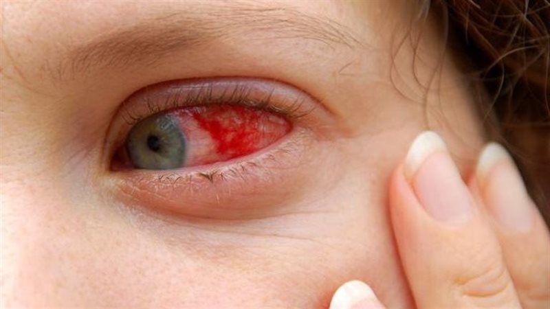 صورة لعين مصابة العين بروماتيزم